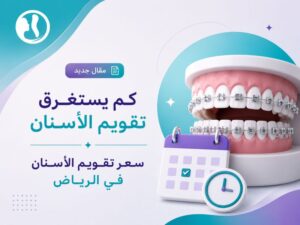 كم يستغرق تقويم الأسنان| سعر تقويم الأسنان في الرياض: فهم المدة والعوامل المؤثرة