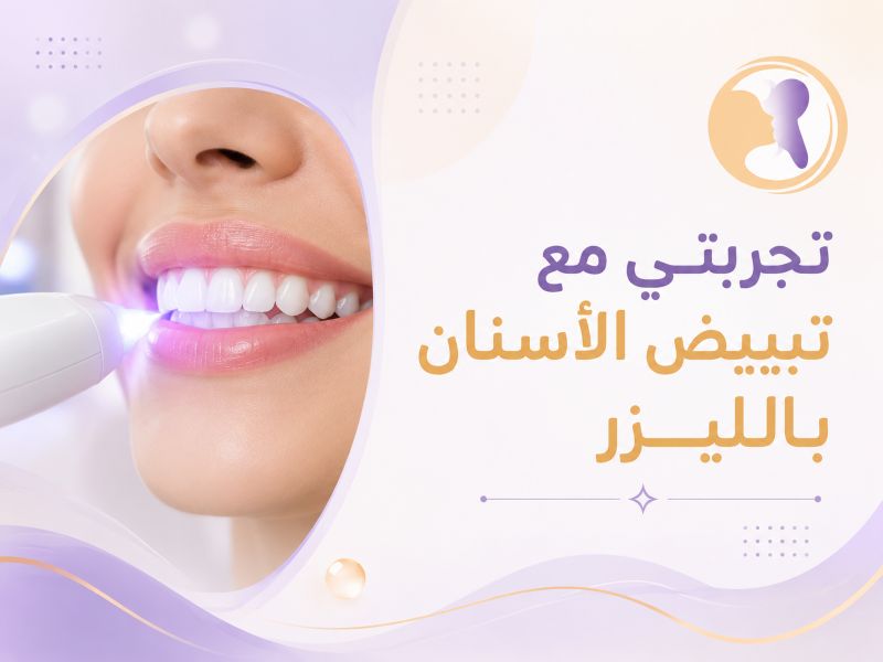 تجربتي مع تبييض الأسنان بالليزر