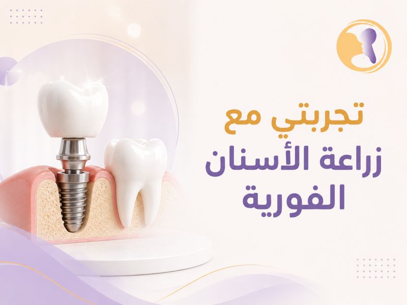 تجربتي مع زراعة الأسنان الفورية