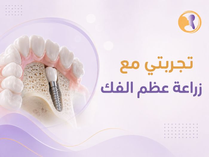 تجربتي مع زراعة عظم الفك