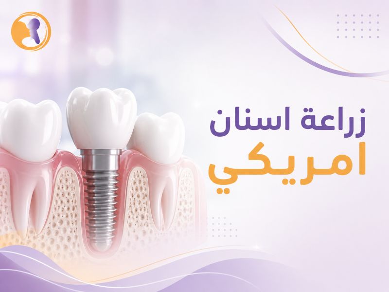 زراعة اسنان امريكي- زراعة الأسنان الأمريكي