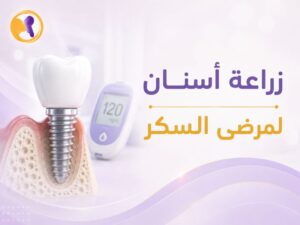 زراعة اسنان لمرضى السكر: اتخذ قرار آمن واحصل على نتائج طويلة الأمد
