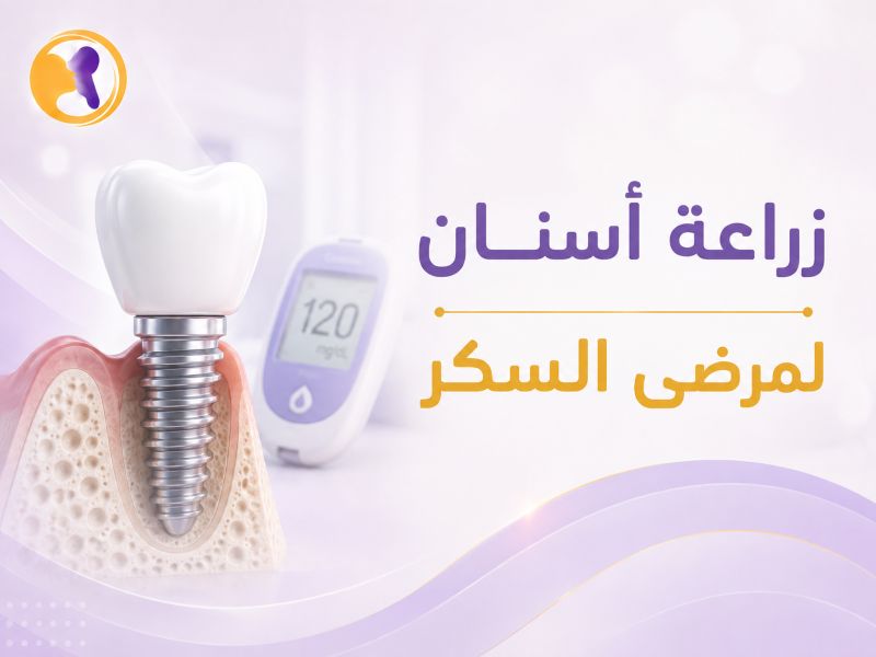 زراعة اسنان لمرضى السكر
