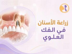 زراعة الأسنان في الفك العلوي: كل ما تحتاجين معرفته قبل اتخاذ قرار الزراعة
