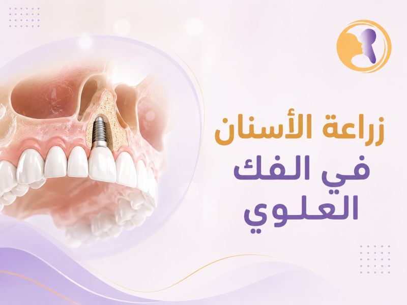 زراعة الأسنان في الفك العلوي