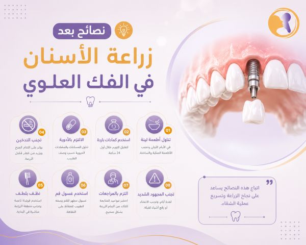 نصائح بعد زراعة الأسنان في الفك العلوي