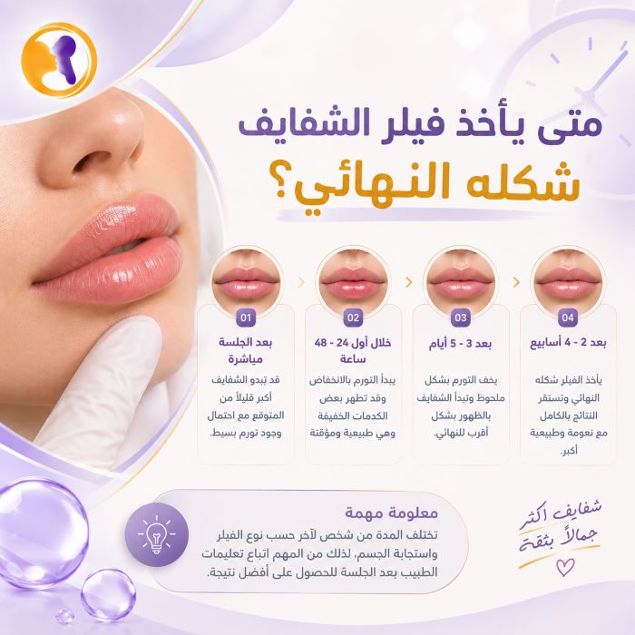 متى -يأخذ- فيلر -الشفايف-شكله- النهائي